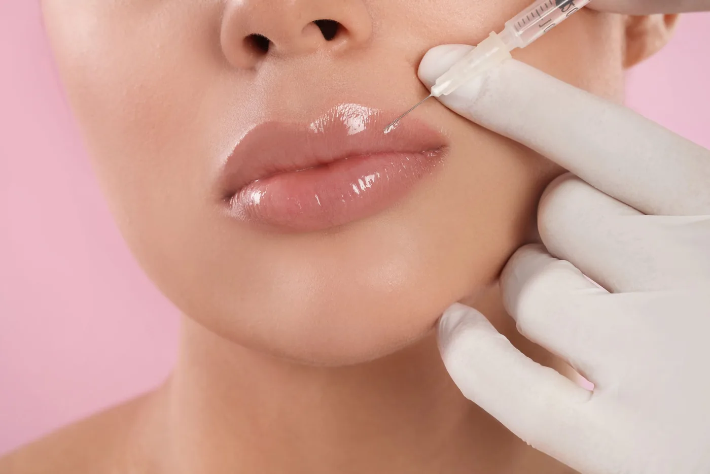 Lip filler injection at Vital Medical Care