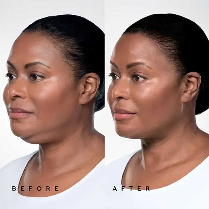 Before and after Endolift
